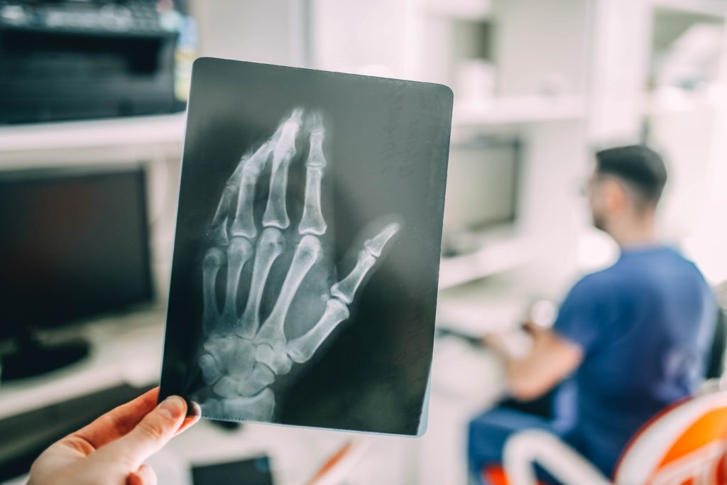X-ray,Picture,Of,A,Hand,With,A,Broken,Little,Finger,